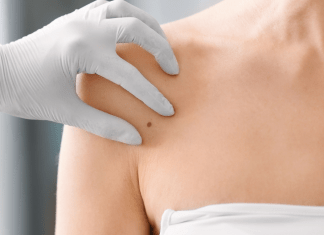 Anyajegyek – mire figyeljünk?